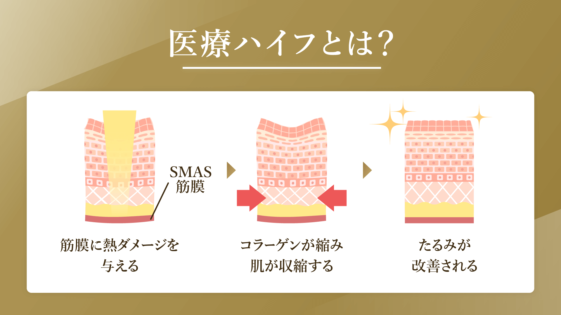 医療ハイフ　おすすめFV